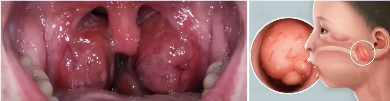 扁桃体肥大一定要切除吗9岁,扁桃体肥大一定要切除吗10岁