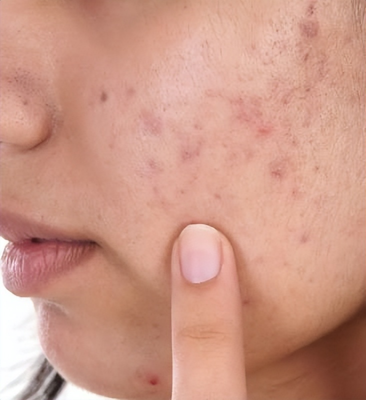 长青春痘了该如何把青春痘消掉,长青春痘的原因及解决方法