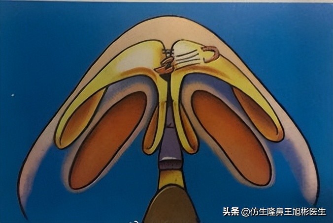 鼻头部位整形,鼻头圆钝高鼻梁整形案例