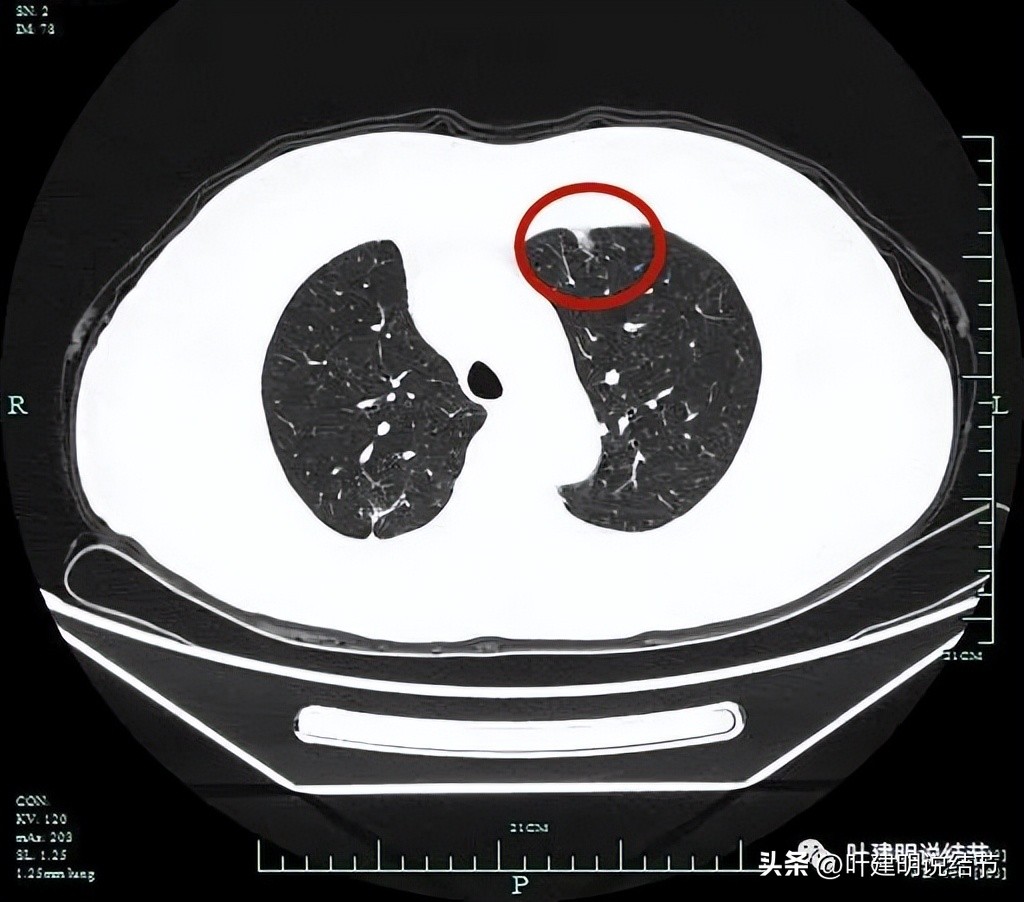 右下叶磨玻璃6mm结节基本上是癌,右下叶少许炎症上叶磨玻璃结节