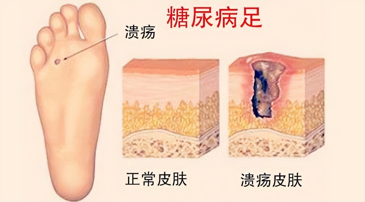 糖尿病开始烂脚了危险吗,糖尿病烂脚去哪家医院看
