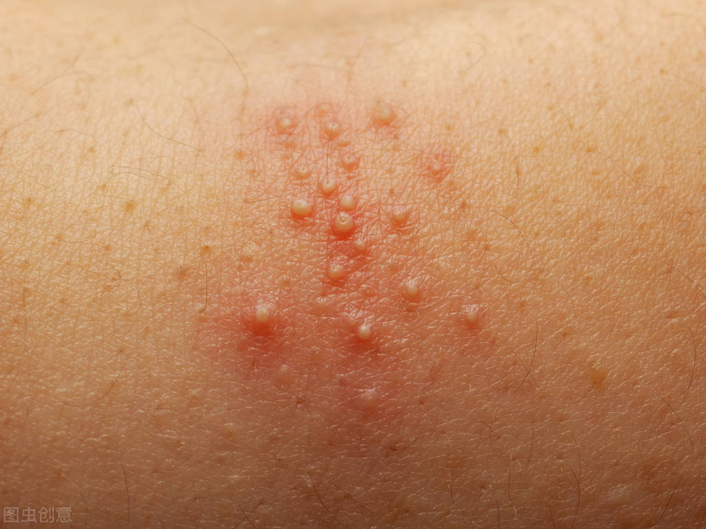 奇痒难耐,就连睡觉也不自觉地抓,怎么办?罗医生教你4招