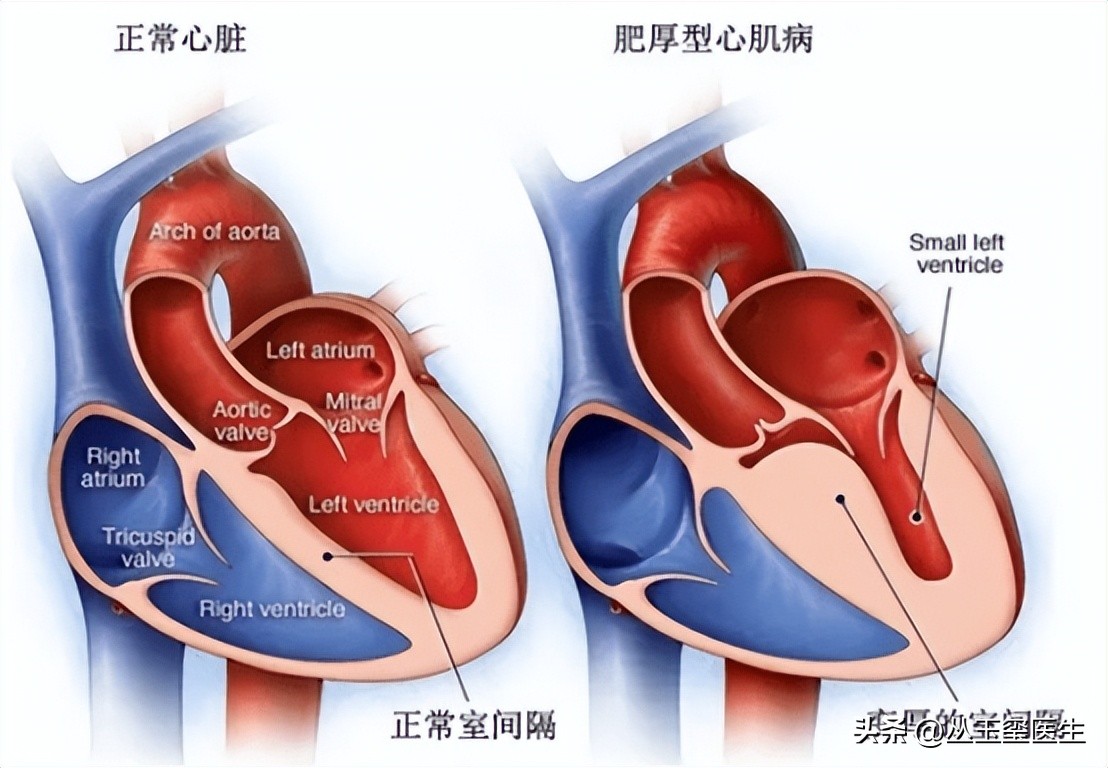 心血管疾病尿毒症,尿毒症最常见的心血管表现