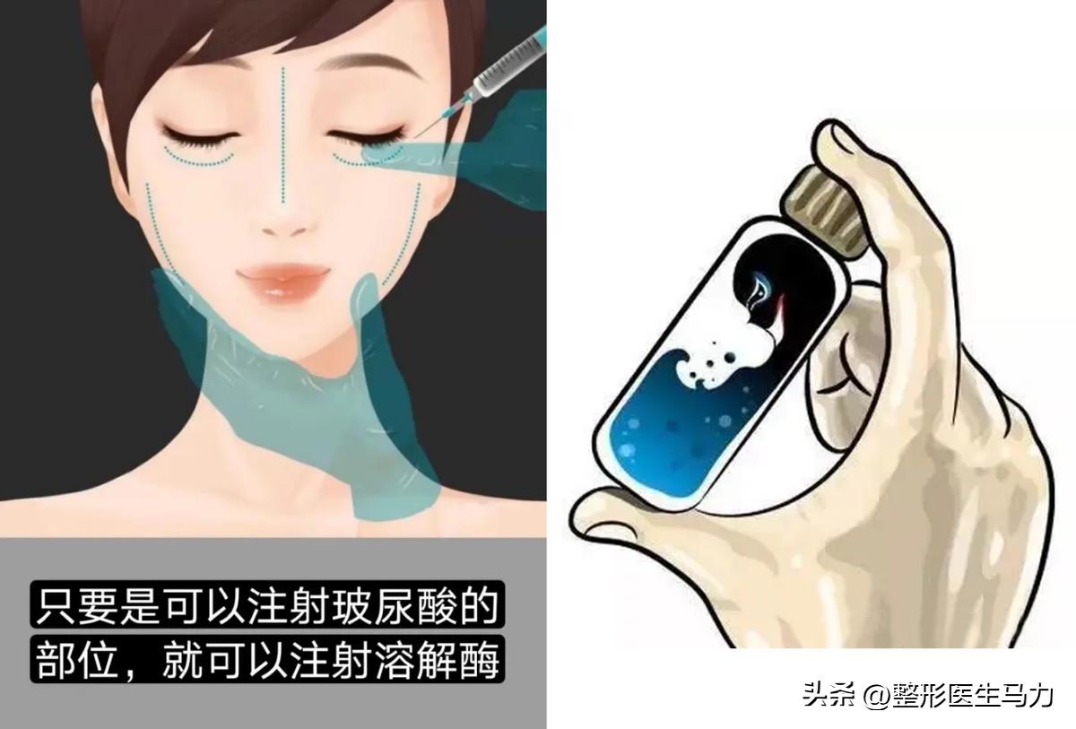 鼻基底玻尿酸栓塞后续治疗方法,鼻基底打玻尿酸栓塞后打溶解酶