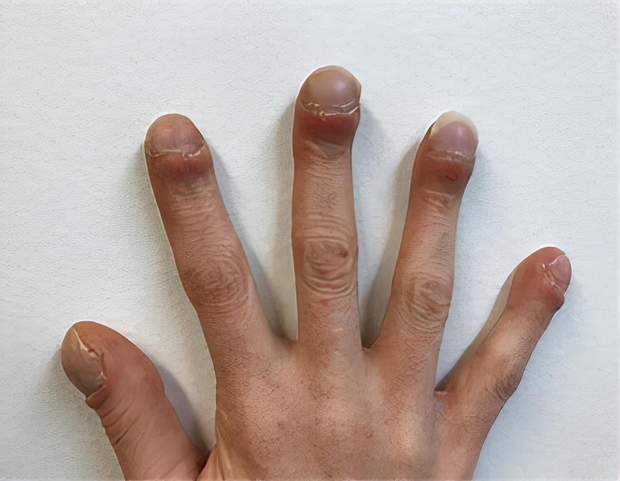 肺癌多是拖出来的,肺癌患者脱发和盗汗是什么情况