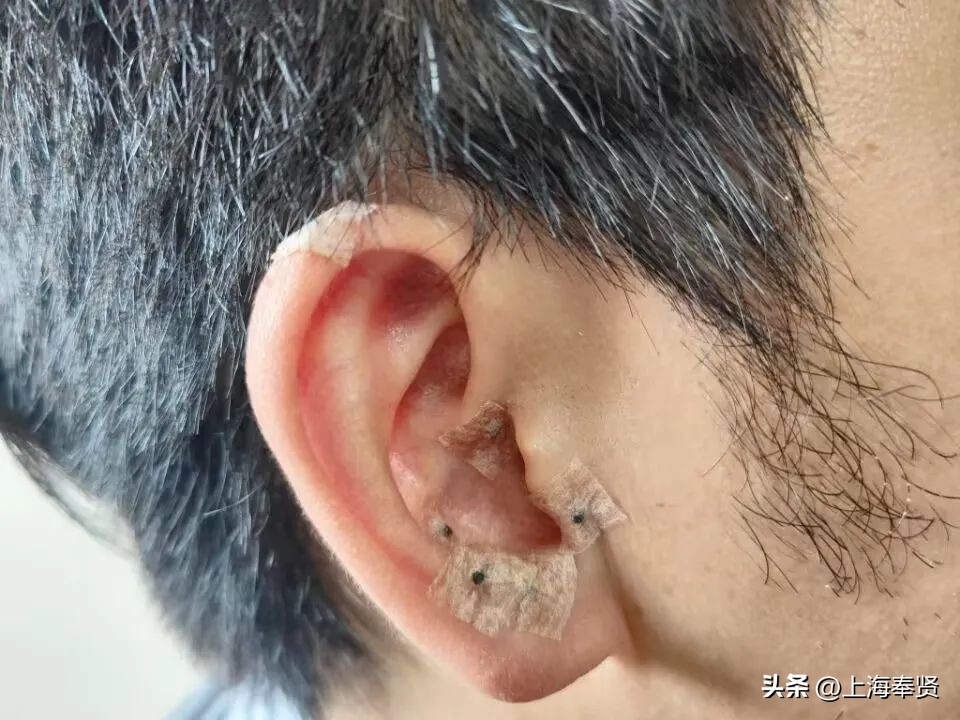 耳穴压丸疗法,耳穴压丸主治什么病