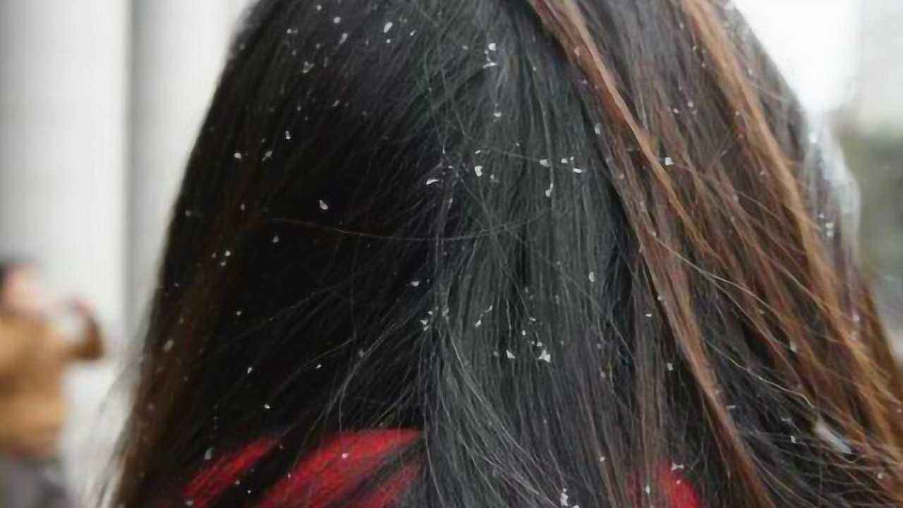 头痒头屑多掉发严重小妙招,治疗头屑头痒脱发的小妙招