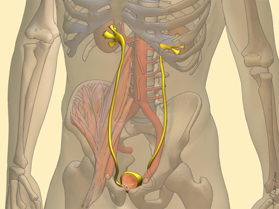 人体结石如何去除,人体结石怎么消除最好的方法