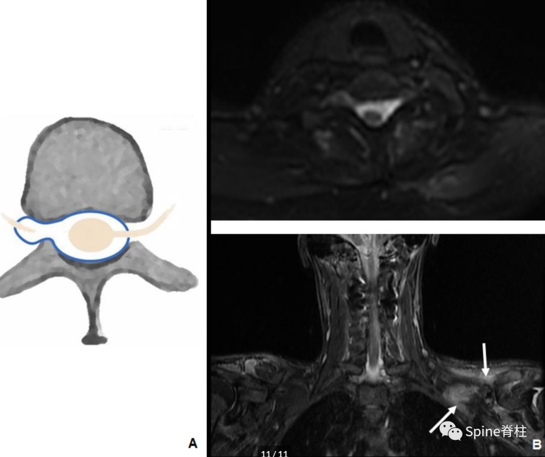 腰椎椎管有囊性结构,水平椎管内囊性占位