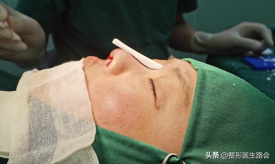 隆鼻失败鼻头有个坑的原因,隆鼻失败导致的鼻头凹陷怎么修复