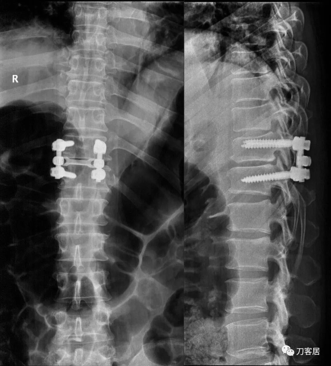 良性单侧下肢肌萎缩,下肢肌肉萎缩24年能治好吗