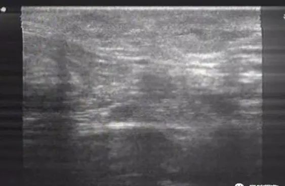 腋窝包块超声鉴别诊断,腋窝淋巴结检查法