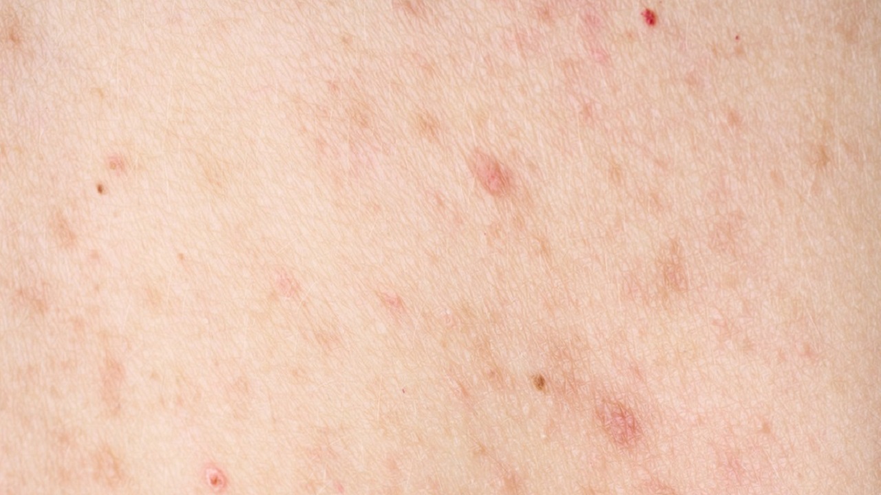 你知道：难以启齿的“阴虱病”，到底是什么吗？它是怎么传播的呢