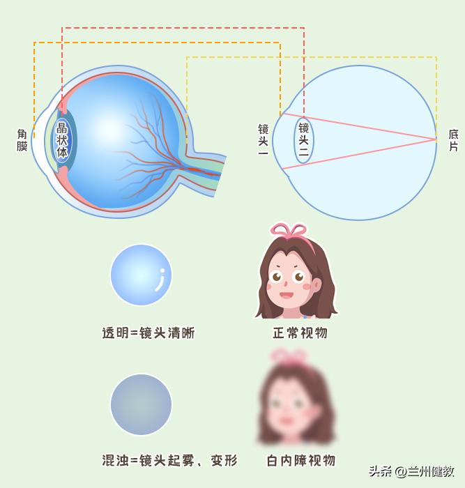关于治疗白内障有效的办法!有什么“特效药”吗?