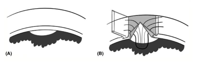 同济大学附属上海东方医院金海鹰教授：巩膜层间缝纫机技术要点