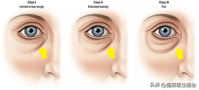 40岁泪沟用什么填充最好,40岁眼袋泪沟最好的解决方法