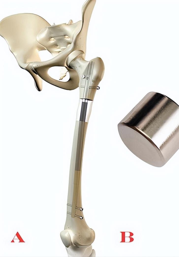 德国断骨增高20厘米,德国最新断骨增高术