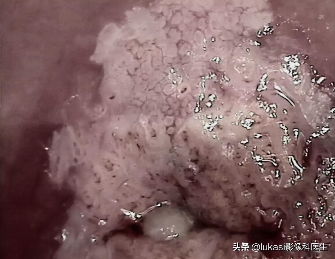 宫颈癌的可怕之处,宫颈癌日益年轻化加强筛查是重点