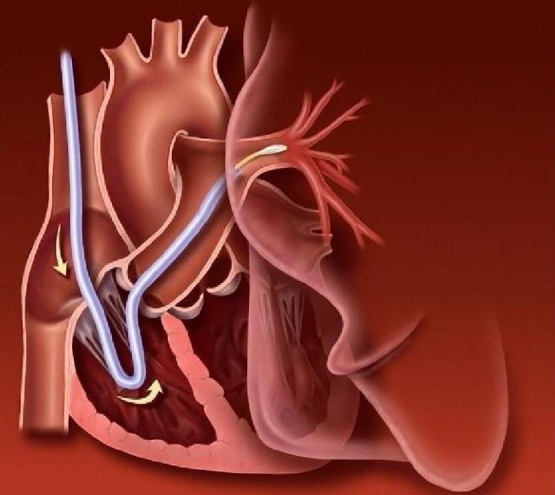 医生科普常见的5种心血管疾病,高死亡率的疾病