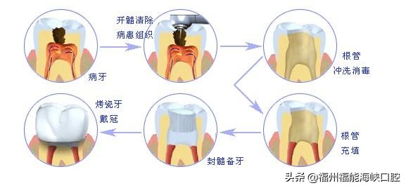 补牙太贵了？过来人表示：搞清楚2个门道后，能省不少