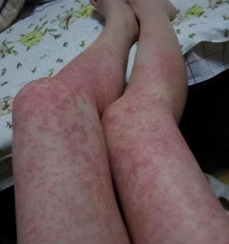 紫癜初期小血点图片,过敏性紫癜中药好还是西药好