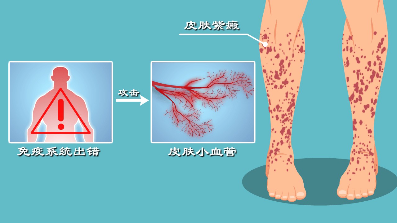 过敏性紫癜青菜不能吃哪几种,紫癜有哪几种原因可以引起