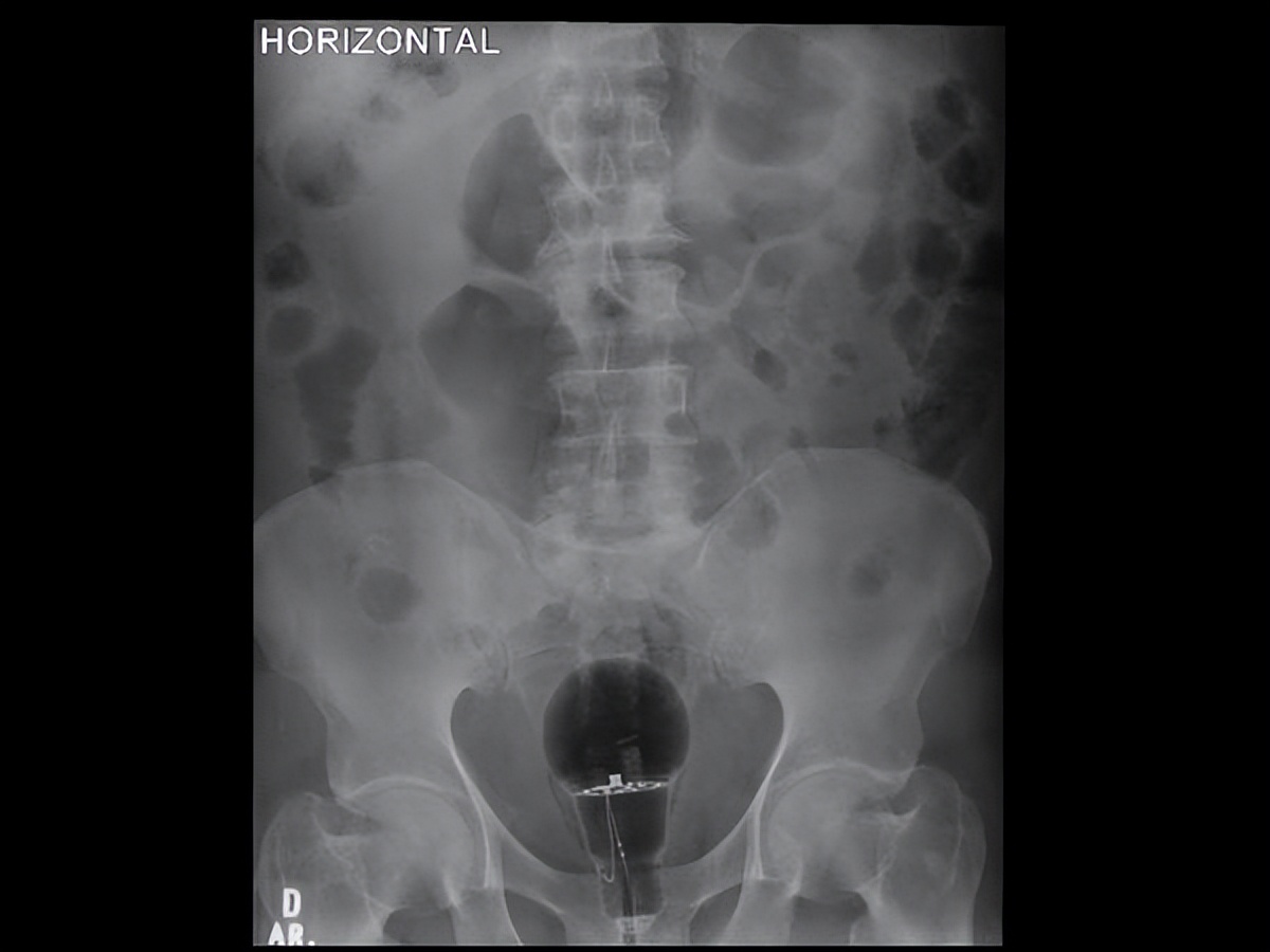 男子将灯泡塞进嘴里,男子把灯泡塞进医院
