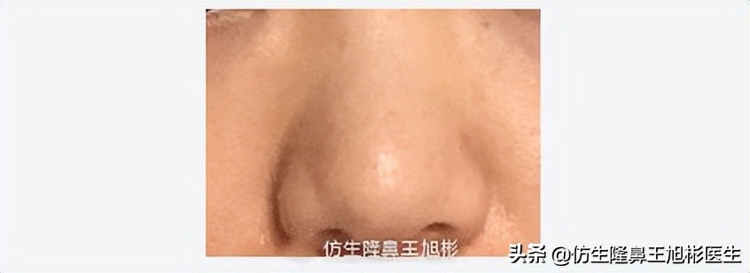 隆鼻鼻头大是失败了吗,大鼻头隆鼻手术案例