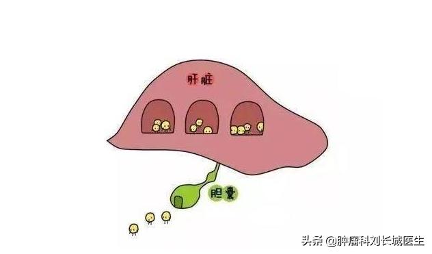 如何鉴别胆囊息肉与胆囊癌,胆囊息肉怎么区分良性恶性