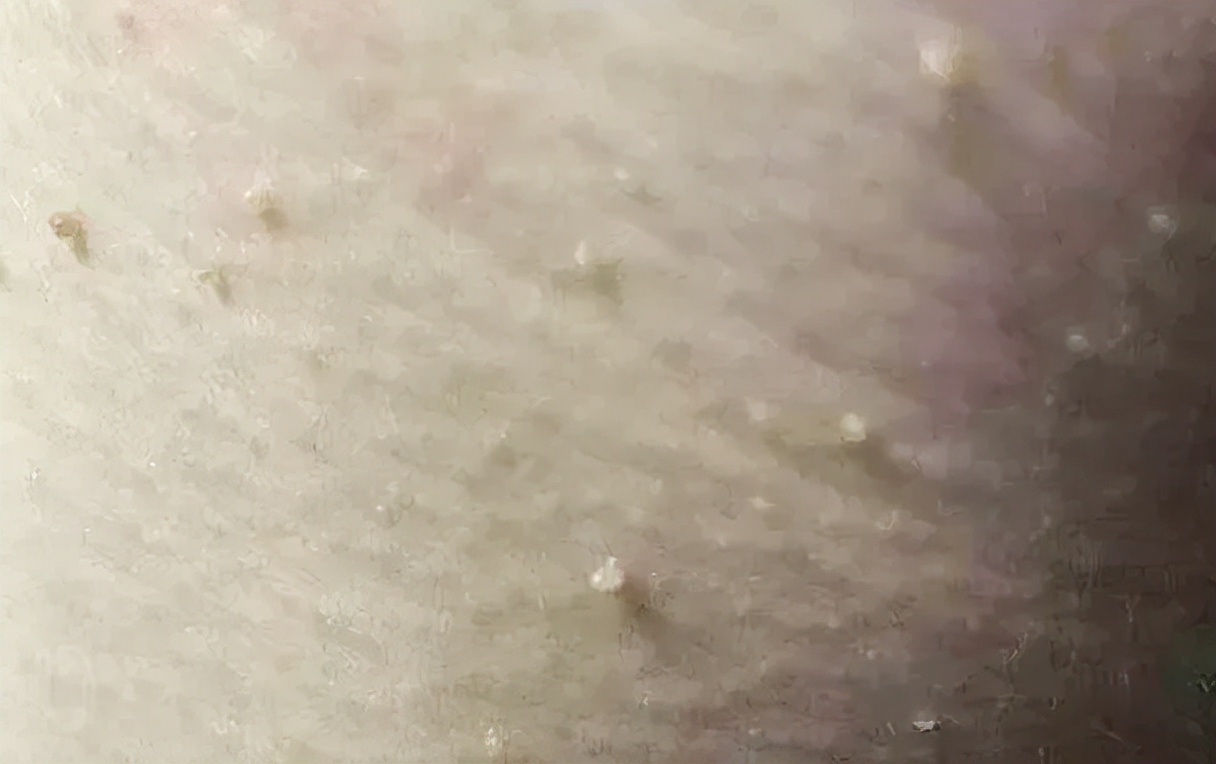 皮肤上的小肉粒是什么东西,皮肤上的肉疙瘩究竟是什么