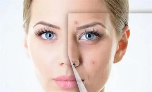 如何让脸上的痘痘一夜之间就能消,怎样可以把脸上的痘痘给消除