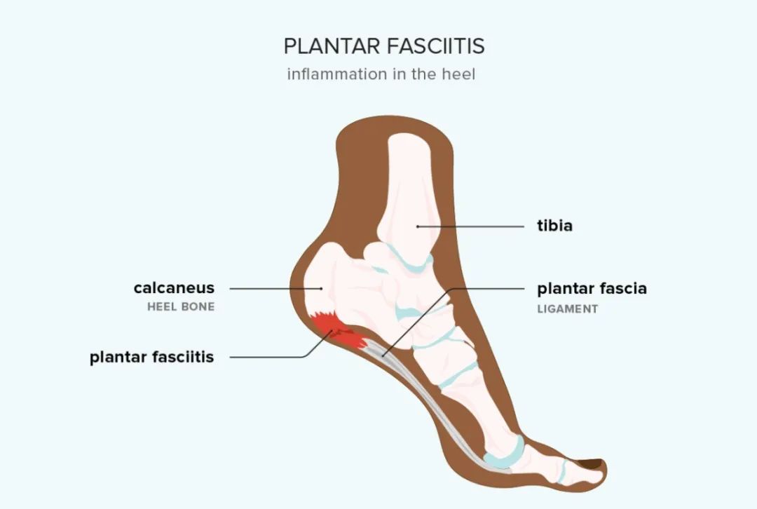 这种损伤，越是重复性的运动，风险越大