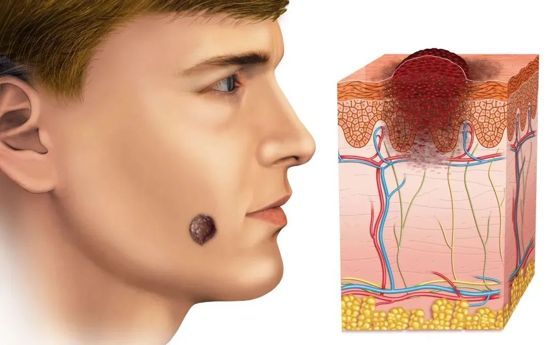 如何判断新长的痣是不是黑色素瘤,正常痣和黑色素痣图片对比说明
