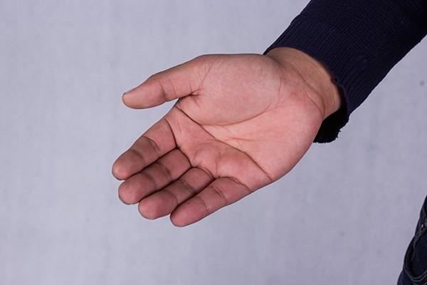 有肝掌的人肝就一定有问题吗,身体出现5个异常