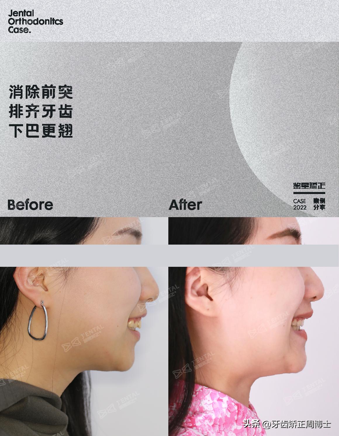 即刻种植即刻修复免受缺牙的痛苦,缺牙不补倾斜矫正价钱