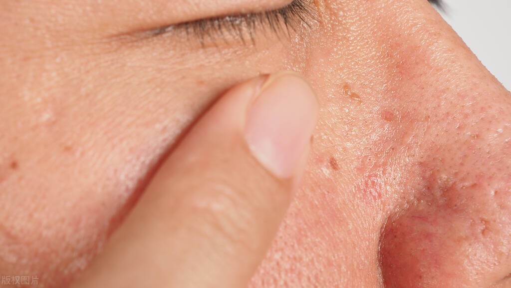 疣与hpv有关系吗,疣和hpv的区别