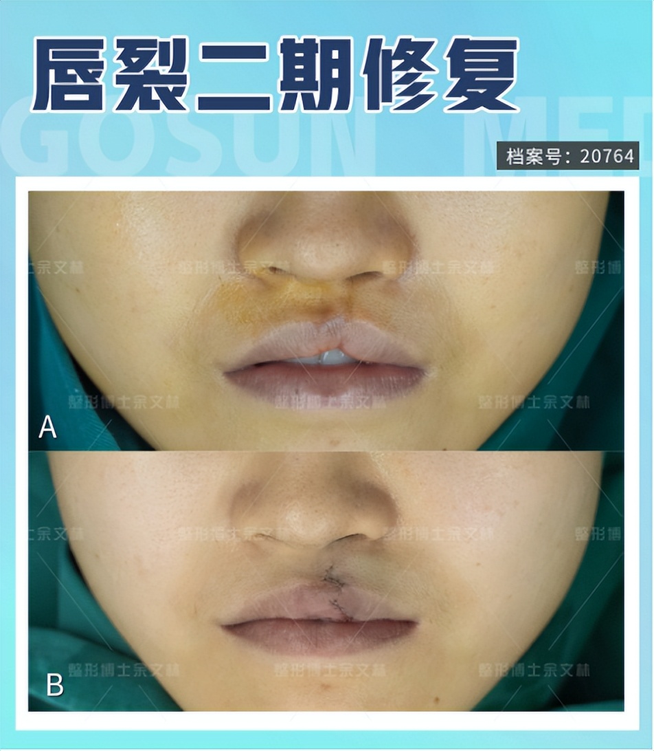 唇裂伴牙槽裂修复效果,唇裂二次修复手术费用