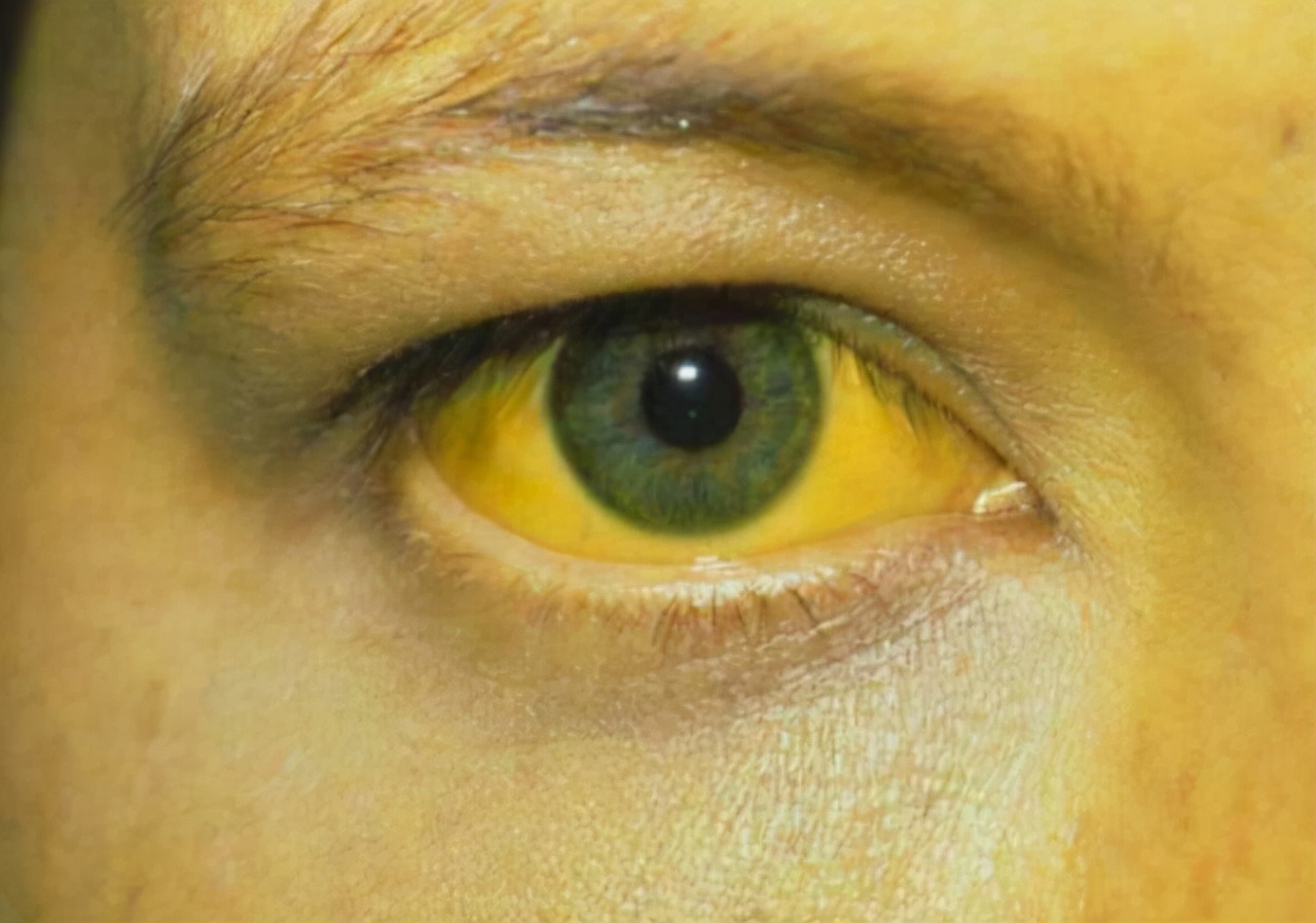 肝脏好不好看眼睛也能知道,肝脏好的人有六种特征