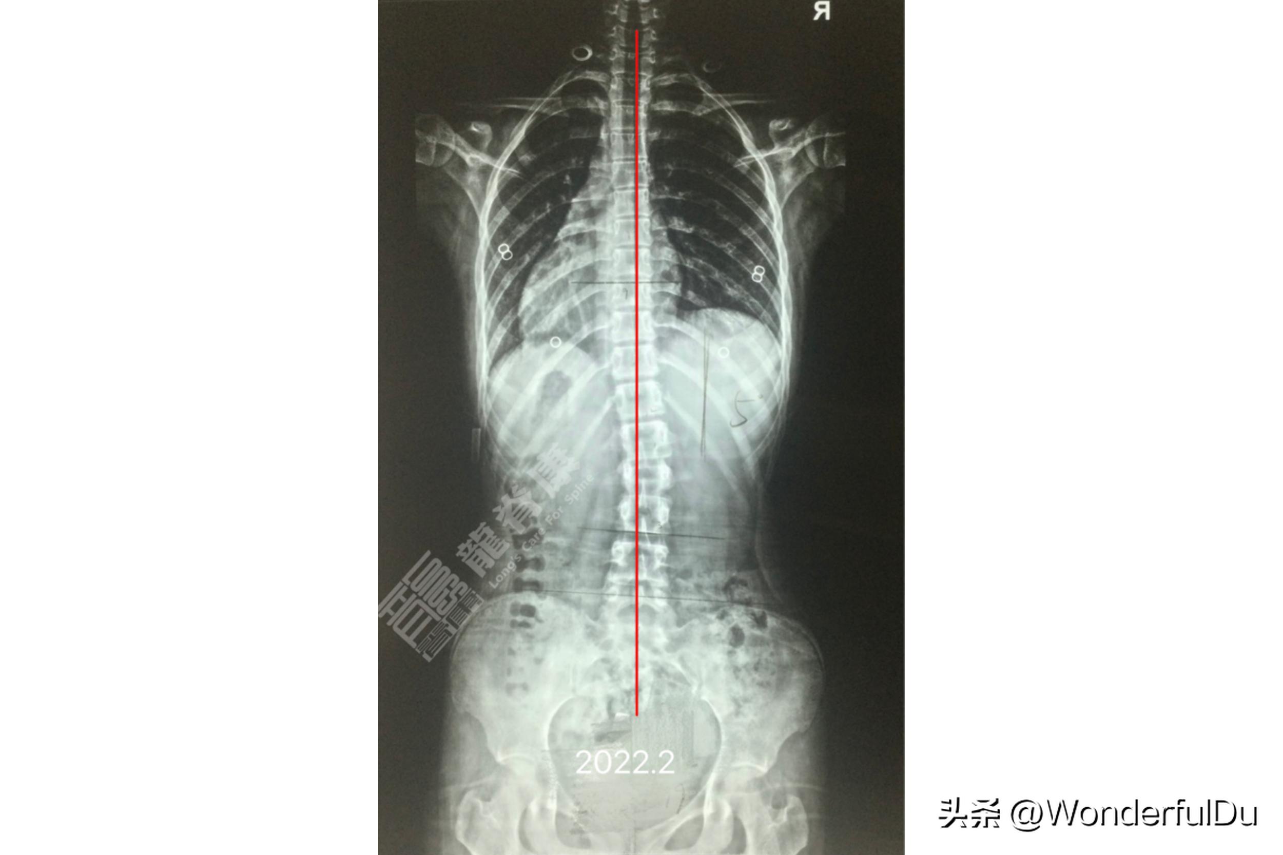 儿童脊柱侧弯导致长短脚怎样矫正,脊柱侧弯引起的长短脚能治愈吗