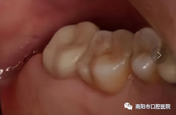 医生问你牙怎么这么不好,医生说我的牙齿裂开了怎么治疗