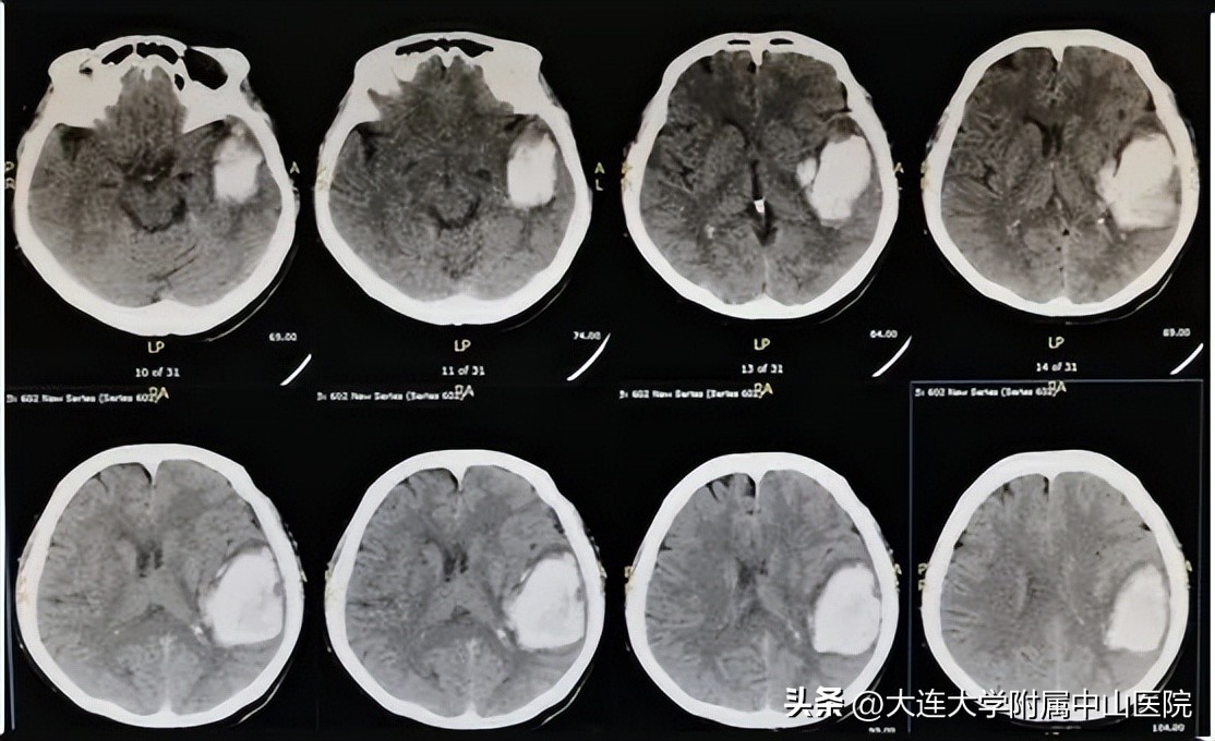 切口清除脑内血肿,内镜下脑内血肿清除的原理