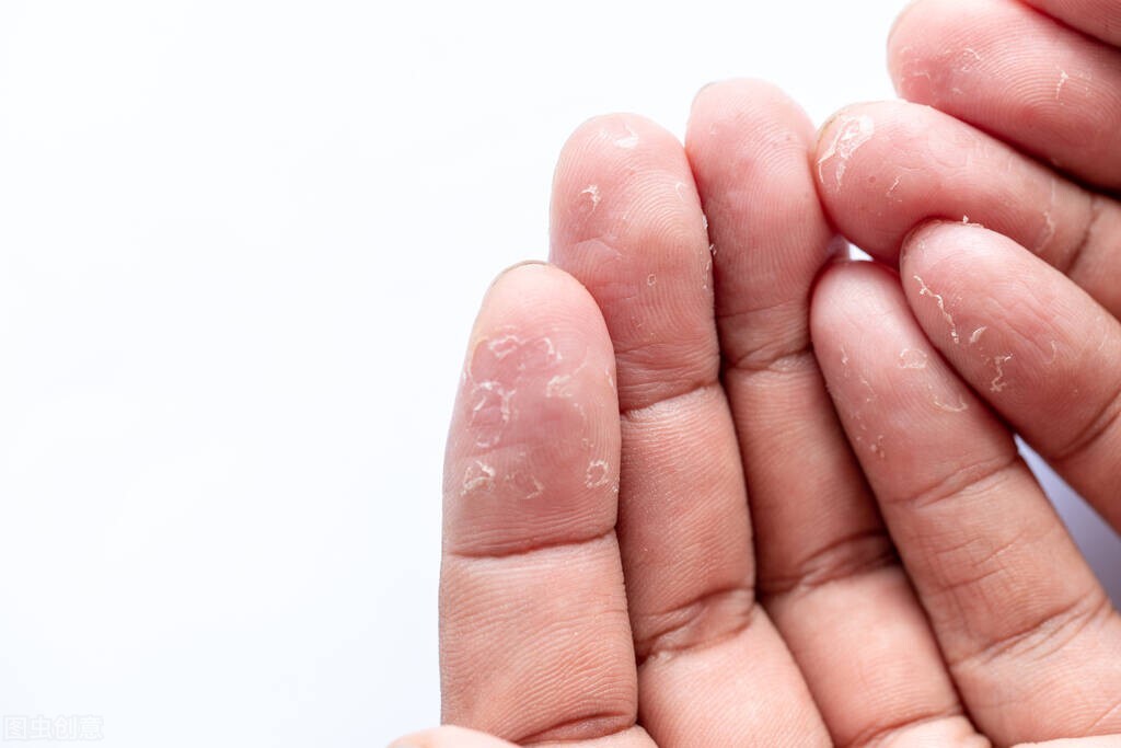 湿疹可以养狗吗,湿疹总反复和养狗有关吗