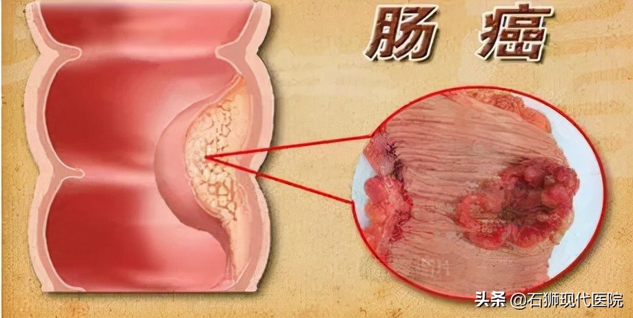 大便时肛门疼痛怎么治疗,大便肛门疼痛用什么药好得快
