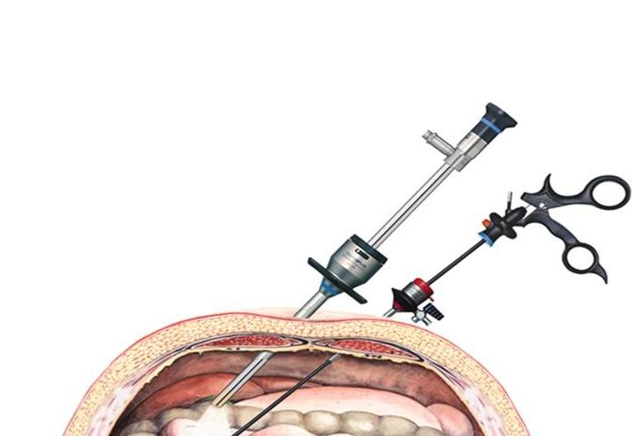 10年没治疗，子宫肌瘤长到4斤，如6个月的婴儿！手术取出109颗
