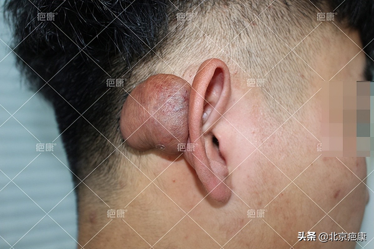 20岁小耳朵切除后恢复图片,耳朵增生疤痕疙瘩切除后要养多久