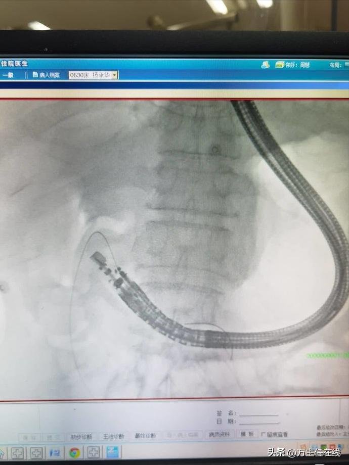 腹腔粘液癌治疗有妙招——万荣教授以内镜Notes技术成功胃减压