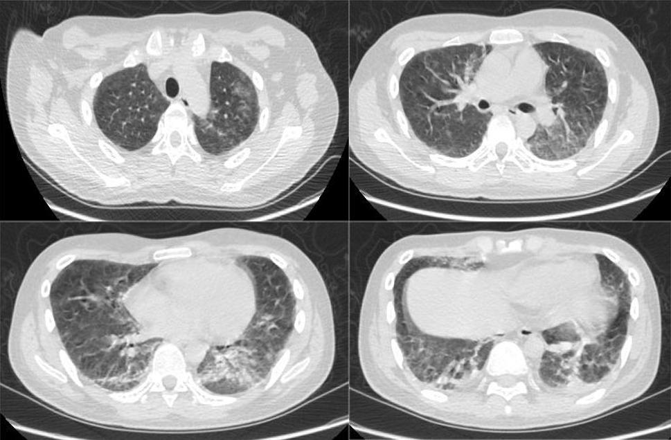 hiv感染肺孢子菌肺炎,hiv患者检查出耶氏肺孢子菌