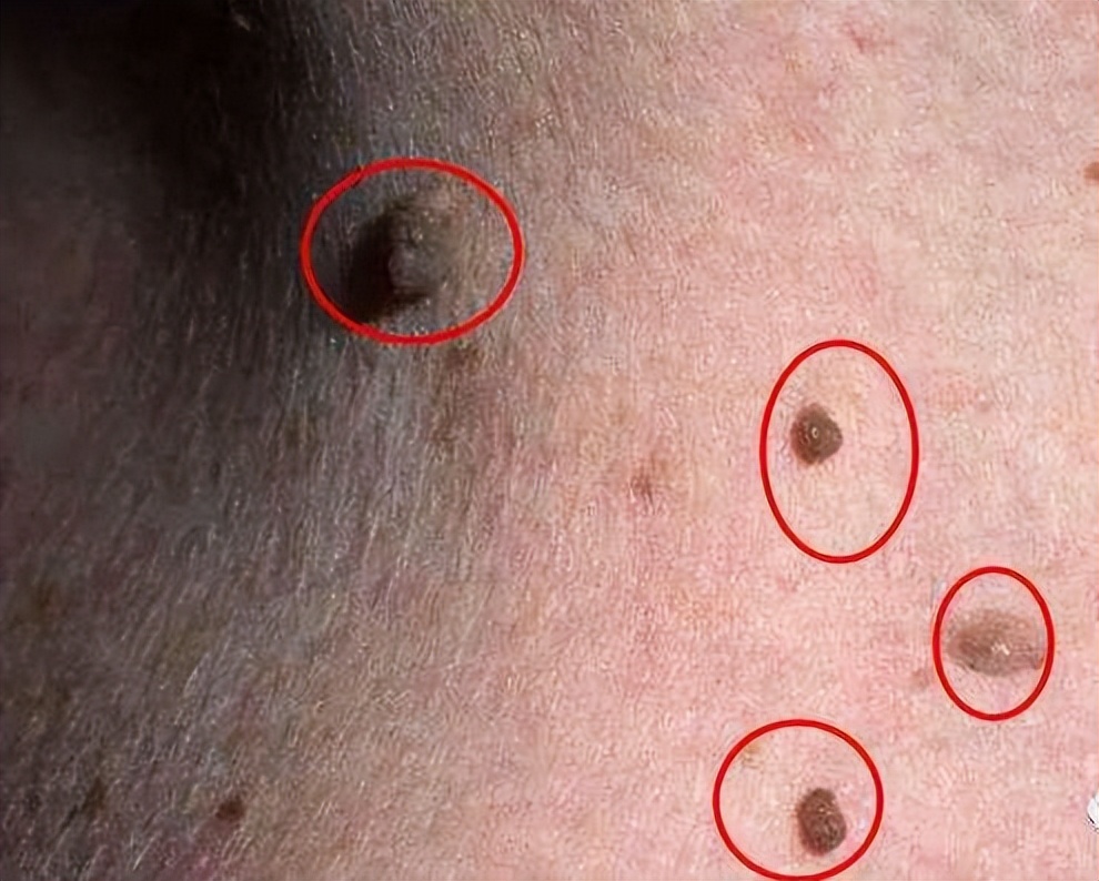 脖子腋下长小肉粒什么原因引起的,脖子上和腋下长小肉粒是什么原因