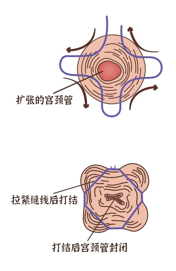 “一根线”兜住宝宝的生命大门！反复流产的妈妈报喜了