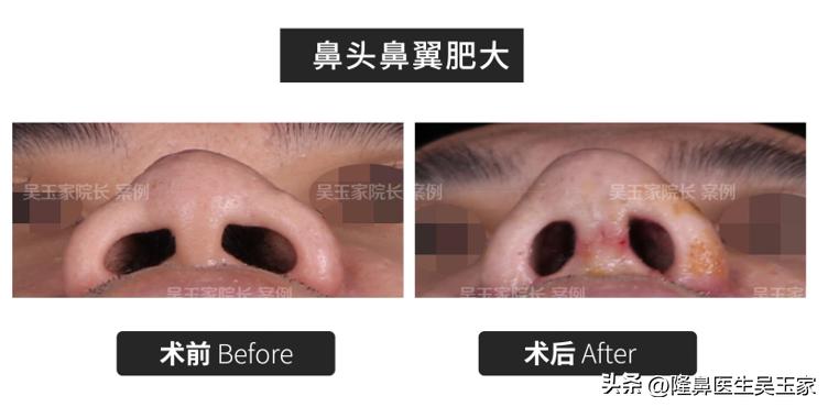 鼻头大整容前后男,鼻头肥大鼻翼宽做手术